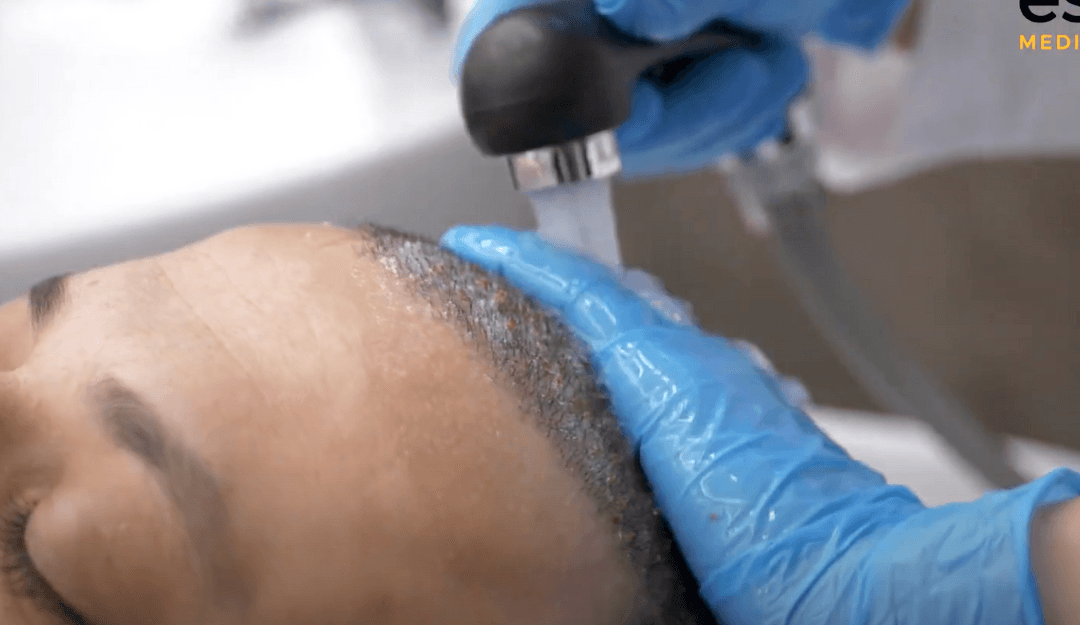 An Exclusive Look Este Hair Transplant Aftercare Este